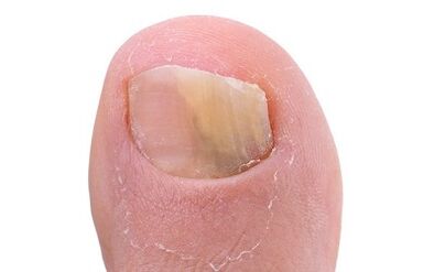 Symptoms of the presence of mushrooms on the go of the leg