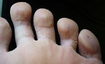 What the fungus looks like on the legs and how to treat it