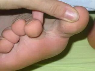 Improvement of the toes