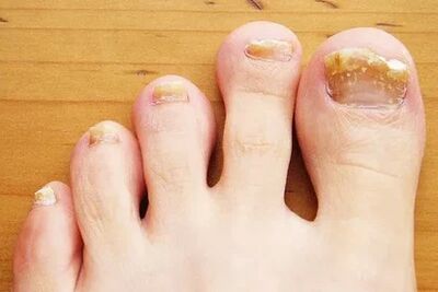 Nail mushroom