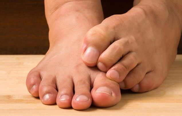 foot fungus and remedies for its treatment