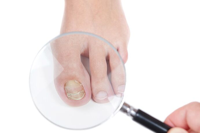 A nail affected by a fungus under a magnifying glass